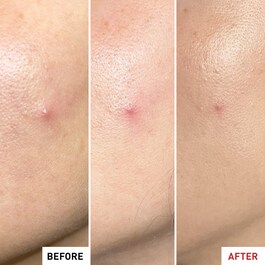 Centella SOS Patch - Gel Anti-borbulhas