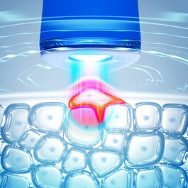 ESPADA Luz azul Terapia - Dispositivo de Tratamento de Acne