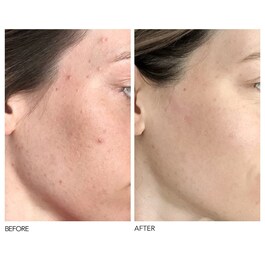 Alpha Beta® - Peeling Diário Fórmula Universal