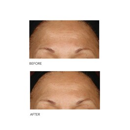 Alpha Beta® - Peeling Diário Fórmula Intensa