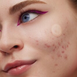 Patches para o tratamento da acne - Microperfuração