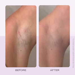 Ingrown Hair Pads - Discos compostáveis para pêlos encravados x60