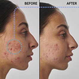 Scar, mark and wrinkle solution with 1% retinol - Sérum Anti-Manchas