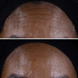 Smart Clinical Repair- Creme Lift Anti Rugas