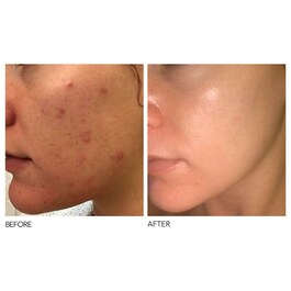 Alpha Beta® - Peeling Diário Fórmula Intensa