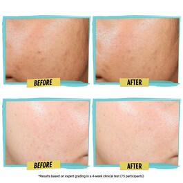 Expertly Clear Blemish Treating & Preventing Lotion