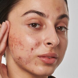 Scar, mark and wrinkle solution with 1% retinol - Sérum Anti-Manchas