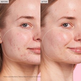 Blackberry Retinol - Sérum de reinicialização