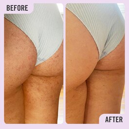 KP Bump Eraser Body Scrub with 10% AHA - Exfoliante Corporal com AHA 