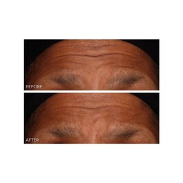 DermInfusions - Gel Regeneração Rápida