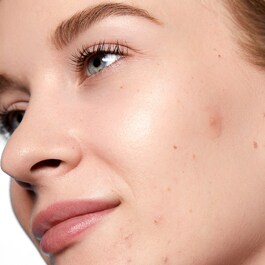 Acne Day Dot - Patchs Anti Imperfeições 