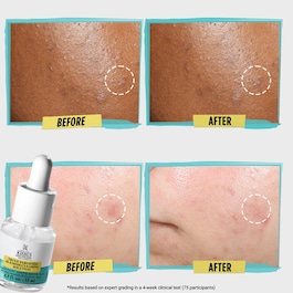 Truly Targeted Blemish-Clearing Solution