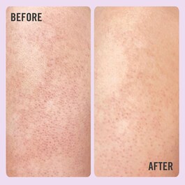 KP Bump Eraser Body Scrub with 10% AHA - Exfoliante Corporal com AHA 