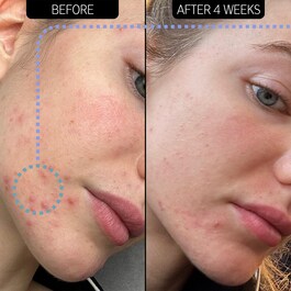 Blemish Clearing Moisturizer  2% NovoRetin™- Hidratante 