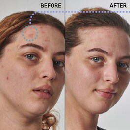 Dry and rough skin slution with 10% urea - Sérum Hidratante