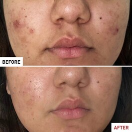 Centella Acne Care - Fluido Calmante
